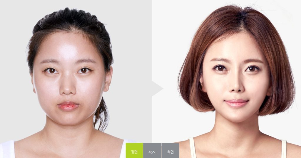 Semi Plastic Surgery In Gangnam