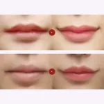 Corner Lip Lift