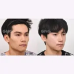 Cheekbone Reduction