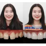 Dental Veneers