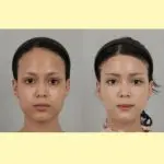 Hairline Forehead Reduction