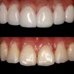 Orthodontic Treatment