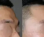 Forehead Implant Surgery