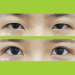Double Eyelid Surgery