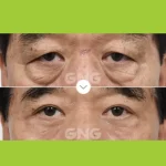 Tear Trough Augmentation
