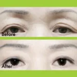 Upper Eyelid Blepharoplasty