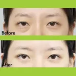 Under Eye Fat Repositioning