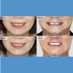 Bruxism and Temporomandibular