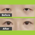 Ptosis Correction
