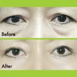 Lower Eyelid Blepharoplasty