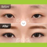 Epicanthoplasty