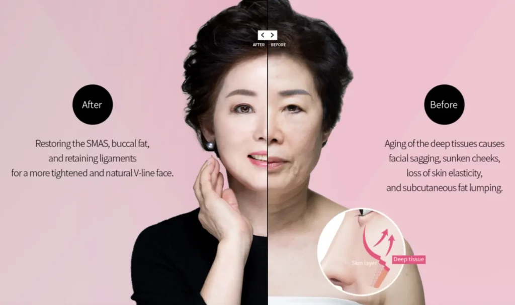 The Top Facelift Hospital for Korean Celebrities: Dream Plastic Surgery Hospital, pioneering multi-layer facial restoration techniques to deeply lift and rejuvenate, creating a naturally youthful appearance