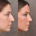 Closed Rhinoplasty