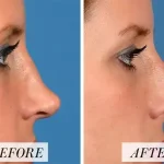 Non implant Rhinoplasty