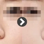Nose Revision Surgery