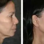 Face Lift