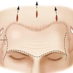 Endoscopic Forehead Lift