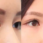 Double Eyelid Revision Surgery